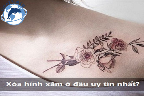 Lựa chọn địa chỉ xóa hình xăm uy tín 